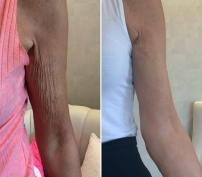 LuxToned Arm Renewal Sleeve
