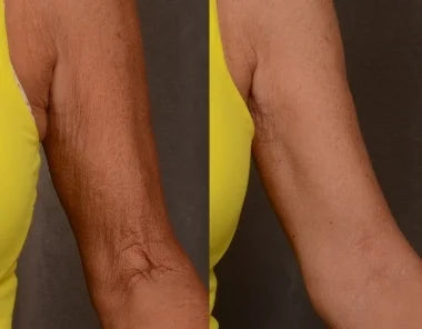 LuxToned Arm Renewal Sleeve